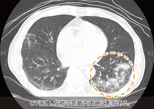 肺炎のCT画像
