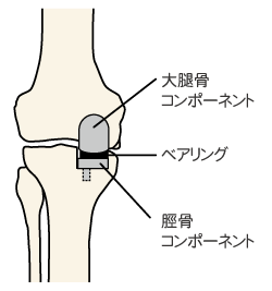 UKA手術のイラスト