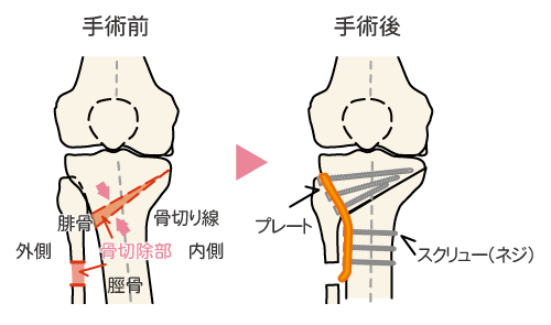 膝の痛い人へ Uka Hto手術 岡山旭東病院